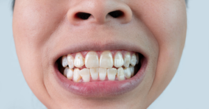 a closeup of a patient’s teeth with white spots